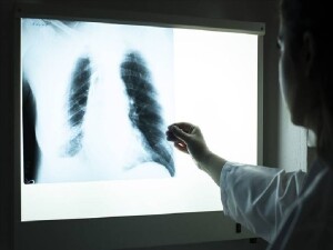 50 yaş altında kanserin hiç olmadığı kadar fazla görülmesinin sebebi açıklandı