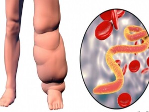 KTFD, Lenfödem farkındalığı için bugün bilgilendirme toplantısı düzenleyecek