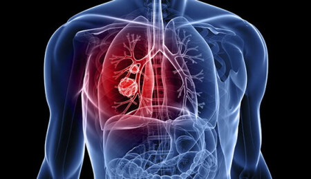 Akciğer Kanseri Belirtileri ve Nedenleri Nelerdir?