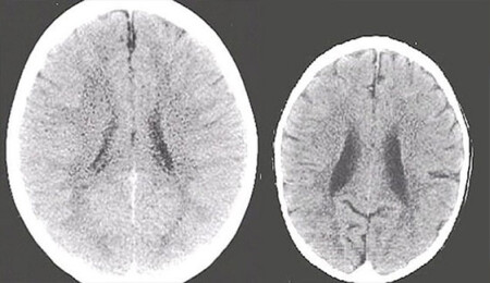 Bilim insanları açıkladı: "İlgi görmeyen çocukların beyni küçülüyor"