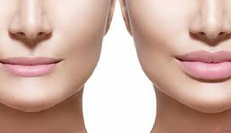 Dudak Dolgusu Sonrası