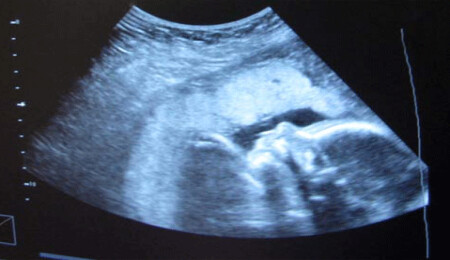 Güney'de 16 yaş altında kürtaj yaptıranlar var