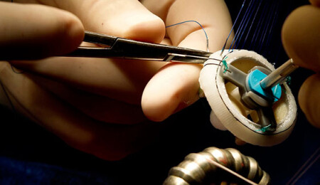 Kalp Kapağı Hastalığı Nasıl Teşhis Edilir? Tedavi Seçenekleri Nelerdir?