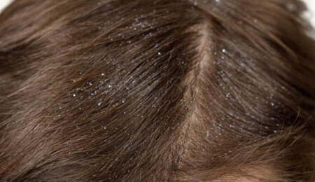 Kepek neden olur? İşte kepekten kurtulmanın doğal yolları…