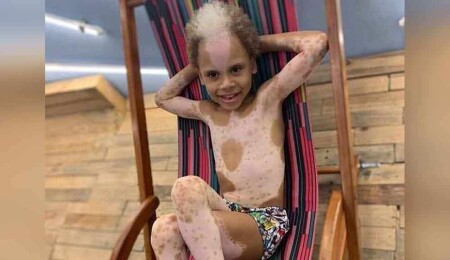 Nadir görülen deri hastalığı olan çocuk, uluslararası model oldu