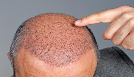 Saç Ekimi Estetiğinin Aşamaları Nelerdir?