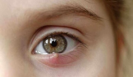 Arpacık nasıl geçer? Arpacık bulaşır mı?