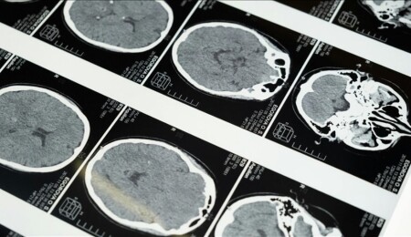 Beyinde Hepatit C virüsü bulundu: Şizofreni ve bipolar semptomlarını açıklayabilir mi?