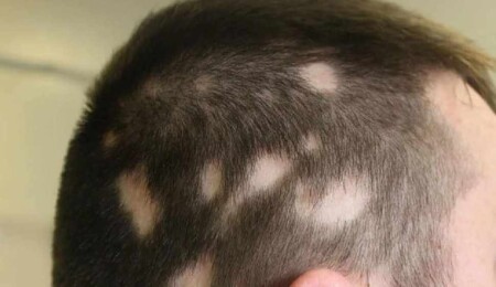 Saçkıranın 8 nedeni