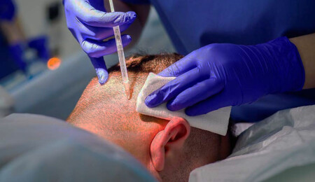 Tabipler Birliği: Çalışma izni olmadan saç ekimi yapanlar tespit edildi!