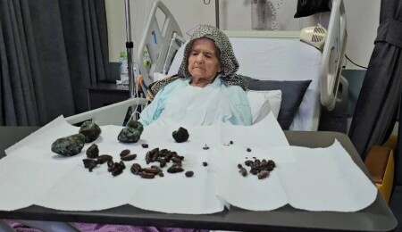 Zonguldak'ta 92 yaşındaki kadının yedikleri taşa dönüştü, organları çürüdü