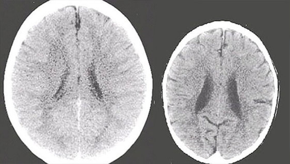 Bilim insanları açıkladı: "İlgi görmeyen çocukların beyni küçülüyor"