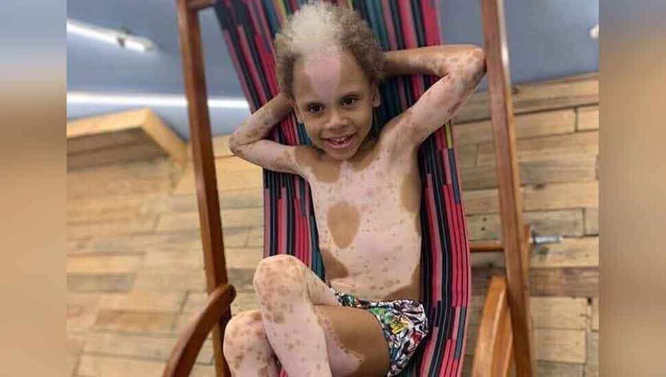 Nadir görülen deri hastalığı olan çocuk, uluslararası model oldu