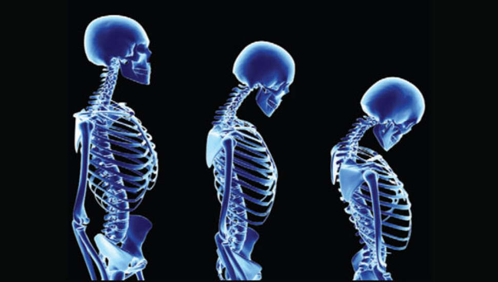 Aşırı alkol ve kafein tüketimi Osteoporoz riskini arttırıyor