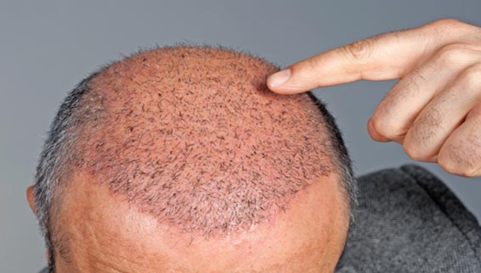 Saç Ekimi Estetiğinin Aşamaları Nelerdir?