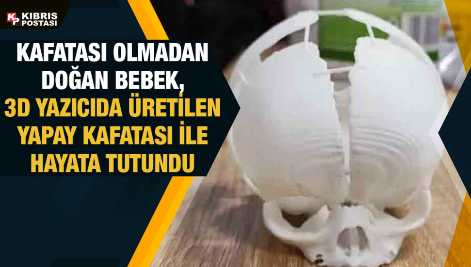Kafatası olmadan doğan bebeğe yapay kafatası üretildi