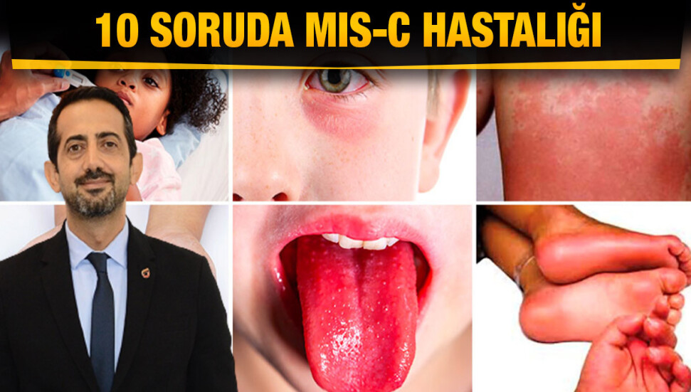 Çocukluklarda Covid-19’a bağlı MIS-C sendromu nedir?