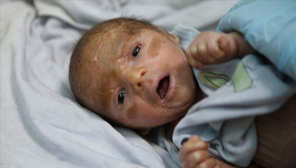 Balık pulu hastası 18 günlük Mutaz tedavi için Türkiye'ye götürüldü