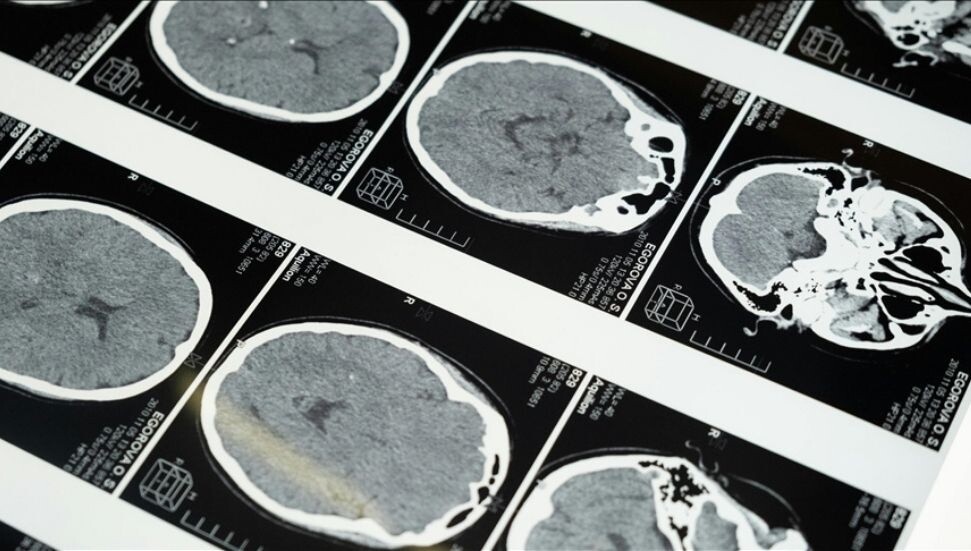 Beyinde Hepatit C virüsü bulundu: Şizofreni ve bipolar semptomlarını açıklayabilir mi?