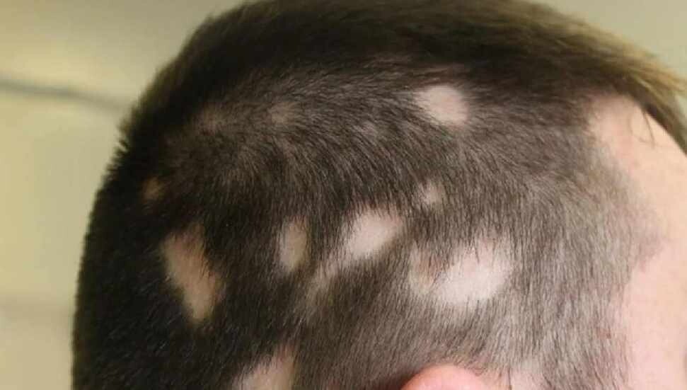 Saçkıranın 8 nedeni