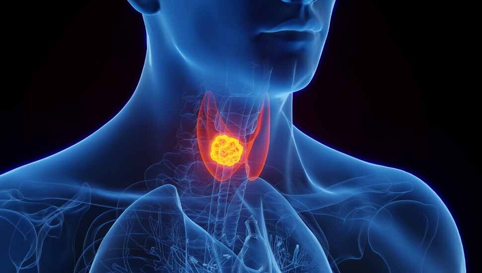 Güney Kıbrıs’ta yeni tiroid kanseri vakalarında artış