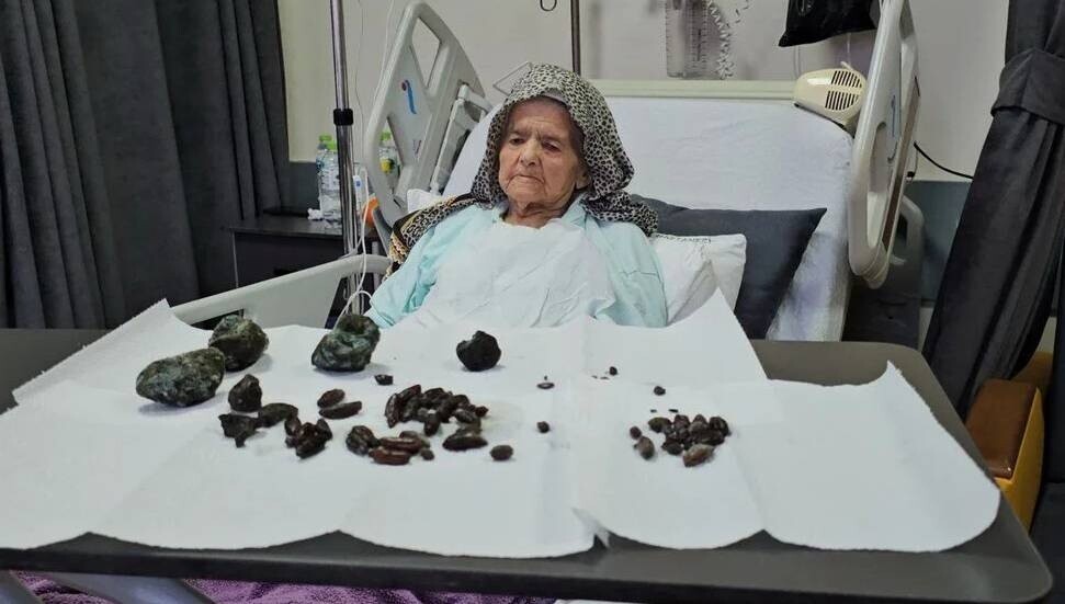 Zonguldak'ta 92 yaşındaki kadının yedikleri taşa dönüştü, organları çürüdü