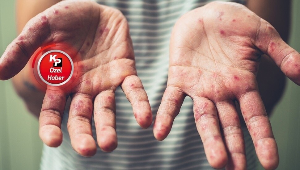 Umut Altunç: Kızamık salgınının başlıca nedeni aşısız kişiler!