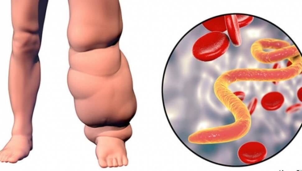 KTFD, Lenfödem farkındalığı için bugün bilgilendirme toplantısı düzenleyecek