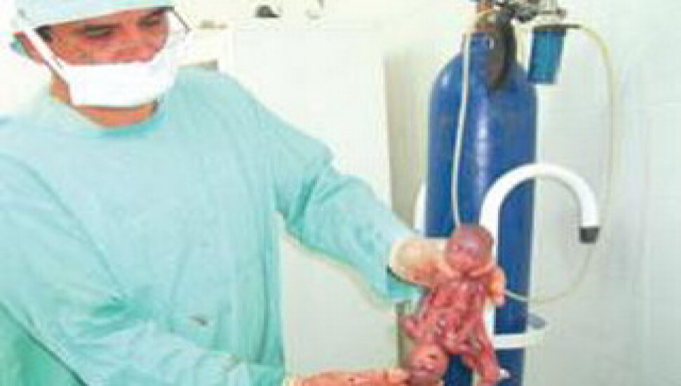 Türkiye'de Yapışık İkiz Vakası