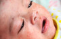 Fourth Death Reported in US as Measles Outbreak Grows