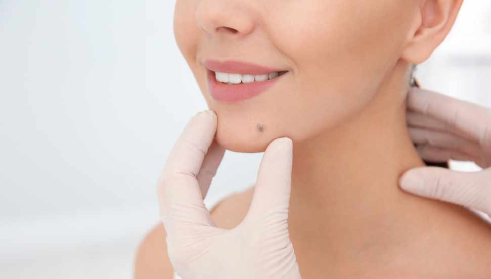 Skin Tag Removal in Dubai