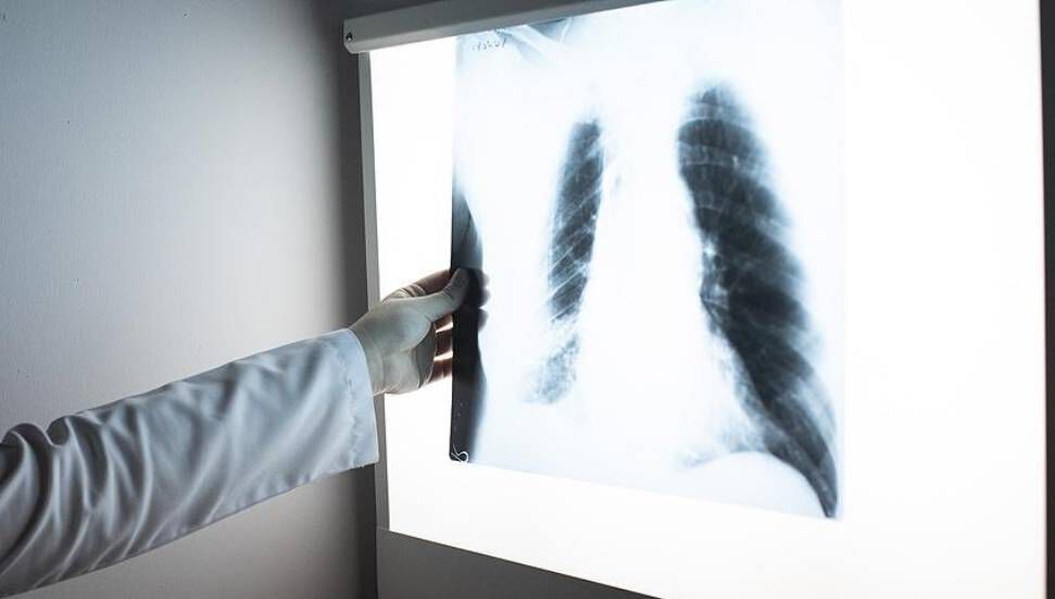 Η φυματίωση παίρνει 1,5 εκατομμύριο ζωές ετησίως στον κόσμο